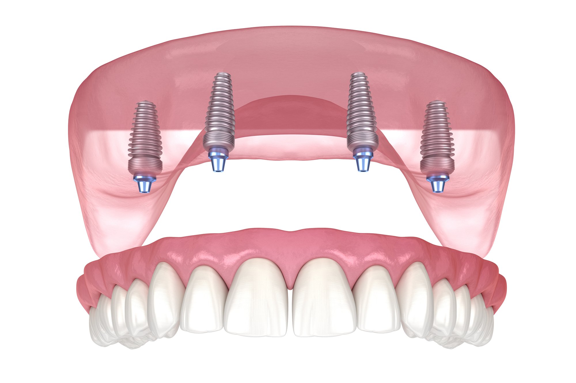 Dental Implants at The Smile Spa in Agoura Hills, CA — Can I Get All-on-4 if I've Worn Dentures for Years?